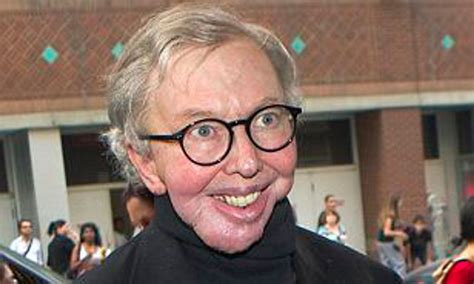 roger ebert|what happened to roger ebert jaw.